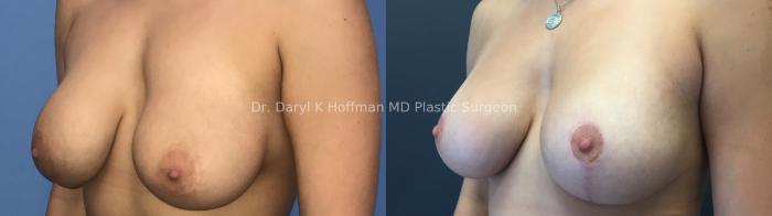 Breast Lift Case 73 Before & After Left Oblique | San Jose & Palo Alto, CA | Daryl K. Hoffman, MD