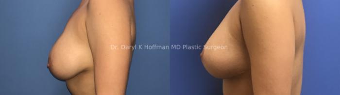 Breast Lift Case 73 Before & After Left Side | San Jose & Palo Alto, CA | Daryl K. Hoffman, MD