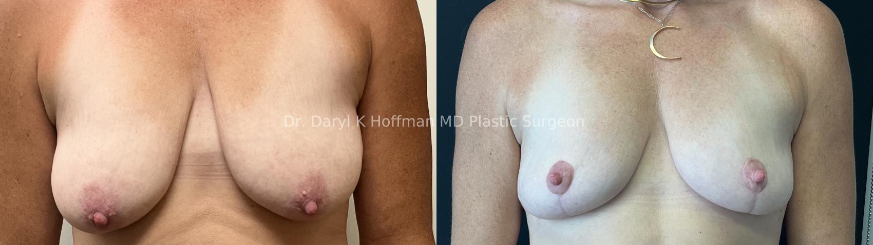 Breast Lift Case 76 Before & After Front | San Jose & Palo Alto, CA | Daryl K. Hoffman, MD