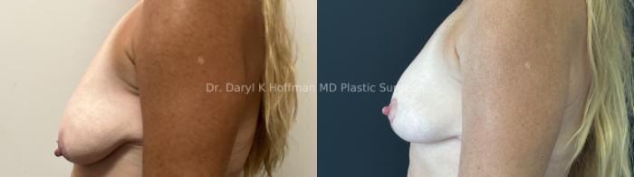 Breast Lift Case 76 Before & After Left Side | San Jose & Palo Alto, CA | Daryl K. Hoffman, MD