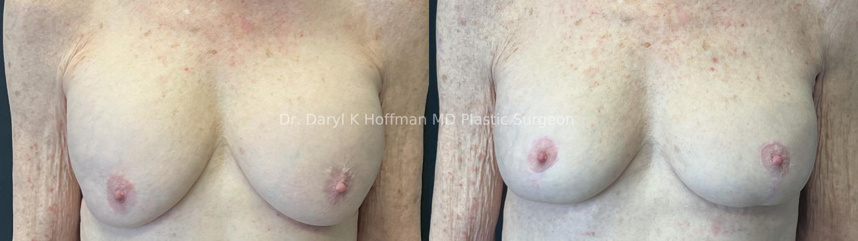 Breast Lift Case 93 Before & After Front | San Jose & Palo Alto, CA | Daryl K. Hoffman, MD
