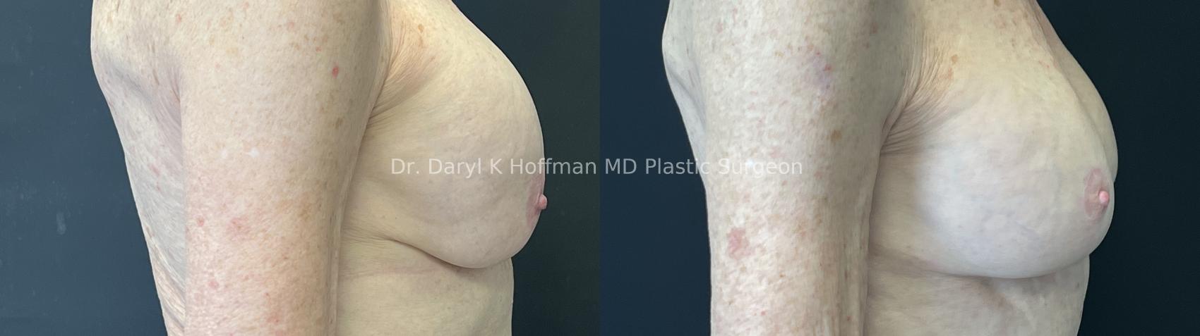 Breast Lift Case 93 Before & After Left Oblique | San Jose & Palo Alto, CA | Daryl K. Hoffman, MD