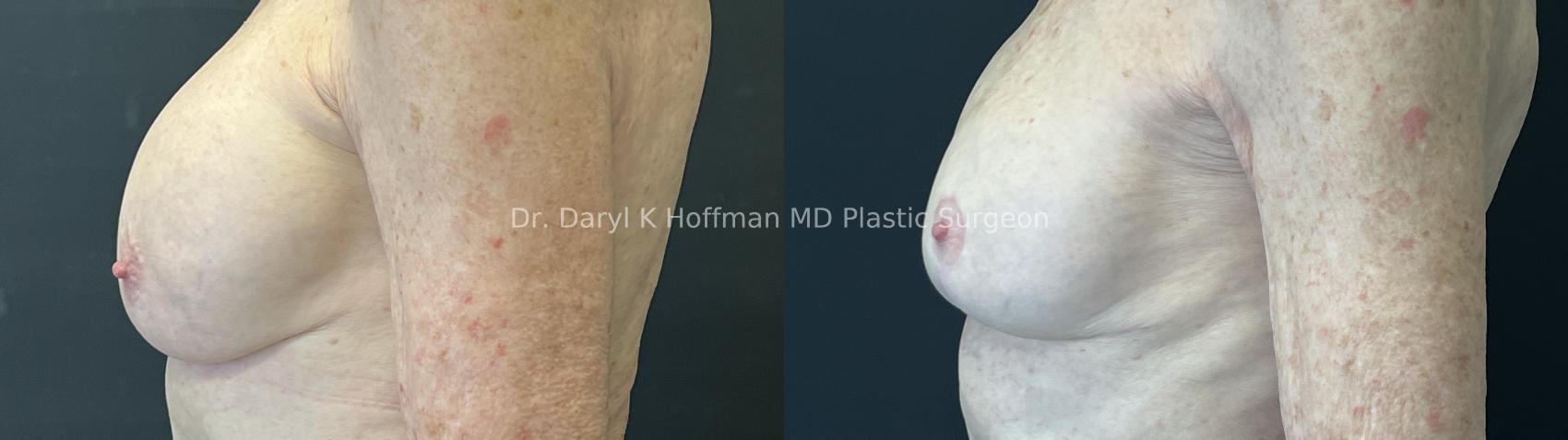 Breast Lift Case 93 Before & After Left Side | San Jose & Palo Alto, CA | Daryl K. Hoffman, MD
