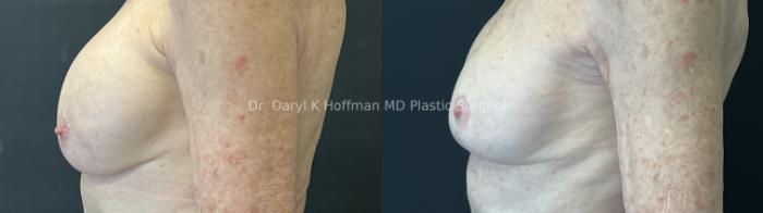 Breast Lift Case 93 Before & After Left Side | San Jose & Palo Alto, CA | Daryl K. Hoffman, MD