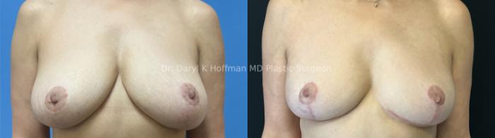 Breast Lift Case 97 Before & After Front | San Jose & Palo Alto, CA | Daryl K. Hoffman, MD