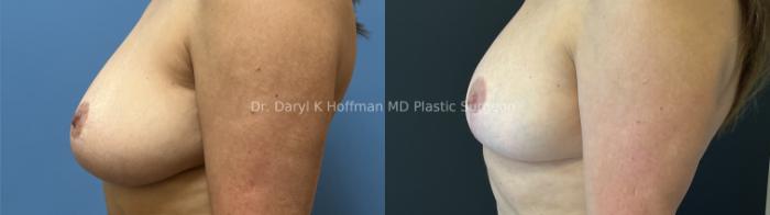 Breast Lift Case 97 Before & After Left Side | San Jose & Palo Alto, CA | Daryl K. Hoffman, MD
