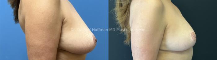 Breast Lift Case 97 Before & After Right Side | San Jose & Palo Alto, CA | Daryl K. Hoffman, MD