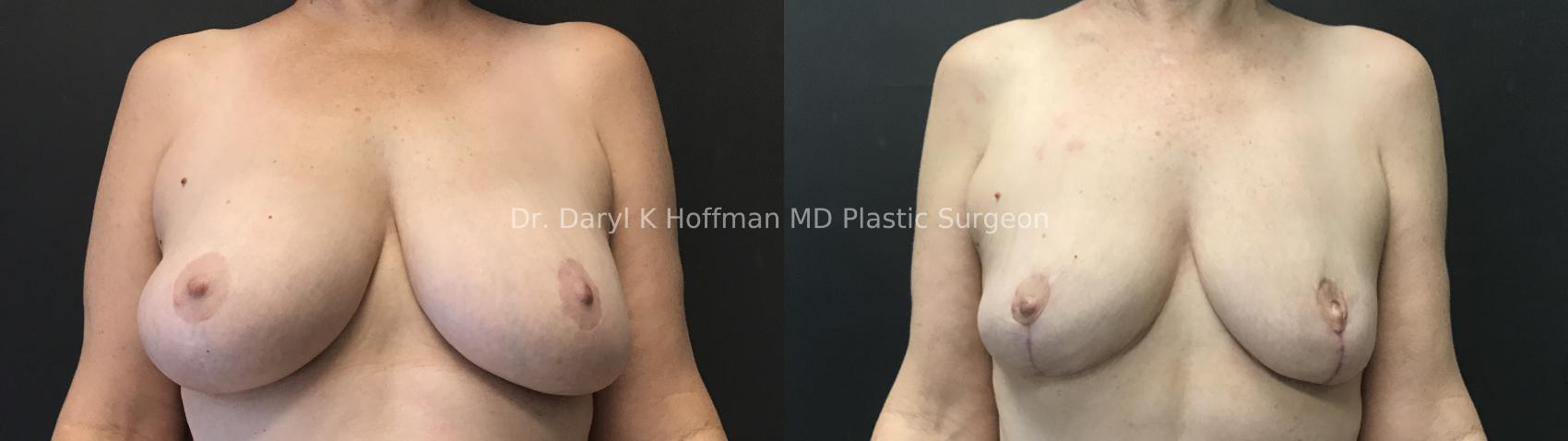 Breast Reduction  Case 83 Before & After Front | San Jose & Palo Alto, CA | Daryl K. Hoffman, MD