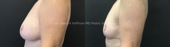 Breast Reduction  Case 83 Before & After Left Side | San Jose & Palo Alto, CA | Daryl K. Hoffman, MD