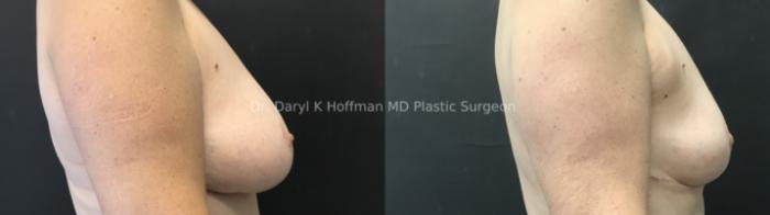 Breast Reduction  Case 83 Before & After Right Side | San Jose & Palo Alto, CA | Daryl K. Hoffman, MD