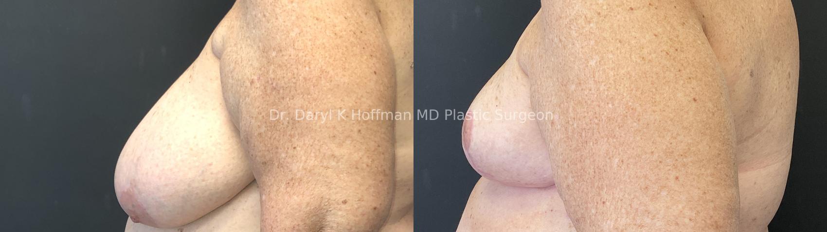 Breast Reduction  Case 87 Before & After Left Side | San Jose & Palo Alto, CA | Daryl K. Hoffman, MD