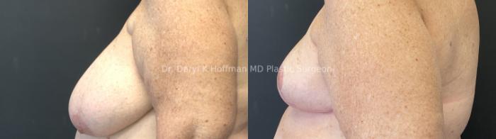 Breast Reduction  Case 87 Before & After Left Side | San Jose & Palo Alto, CA | Daryl K. Hoffman, MD