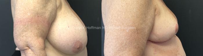 Breast Reduction  Case 87 Before & After Right Side | San Jose & Palo Alto, CA | Daryl K. Hoffman, MD