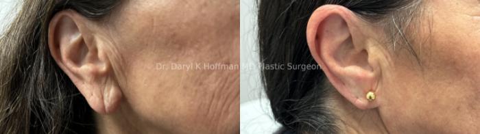 Earlobe Repair  Case 70 Before & After Left Side | San Jose & Palo Alto, CA | Daryl K. Hoffman, MD