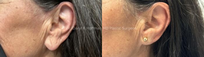 Earlobe Repair  Case 70 Before & After Right Side | San Jose & Palo Alto, CA | Daryl K. Hoffman, MD