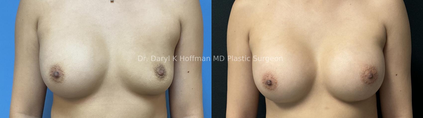 Implant Exchange  Case 84 Before & After Front | San Jose & Palo Alto, CA | Daryl K. Hoffman, MD