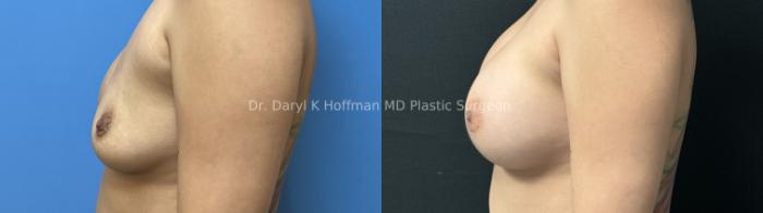 Implant Exchange  Case 84 Before & After Left Side | San Jose & Palo Alto, CA | Daryl K. Hoffman, MD