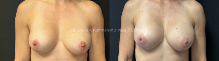 Implant Exchange  Case 91 Before & After Front | San Jose & Palo Alto, CA | Daryl K. Hoffman, MD