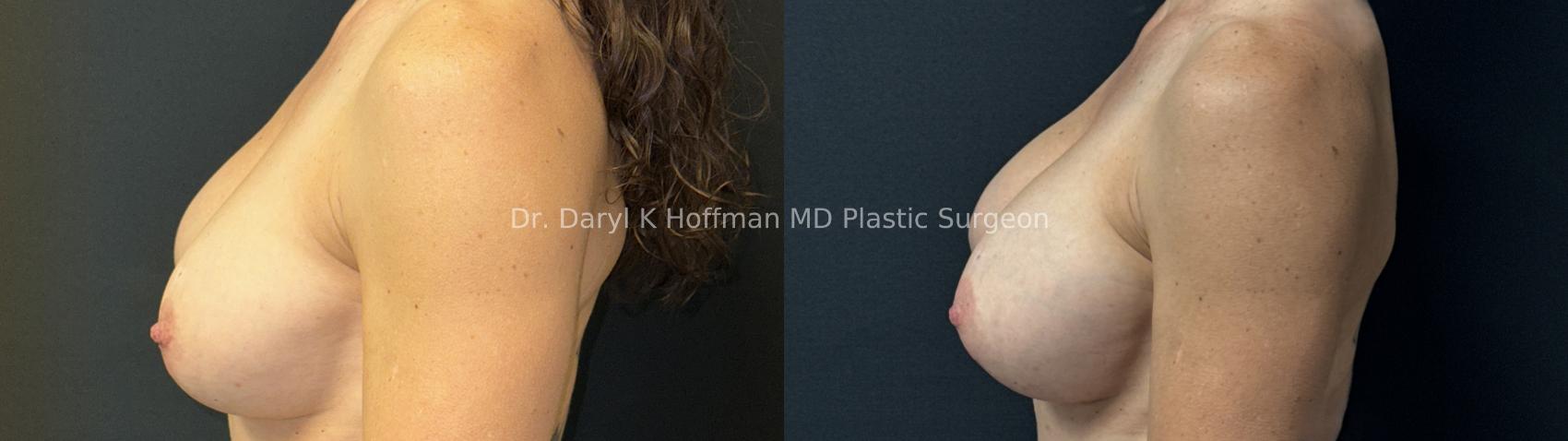 Implant Exchange  Case 91 Before & After Left Side | San Jose & Palo Alto, CA | Daryl K. Hoffman, MD