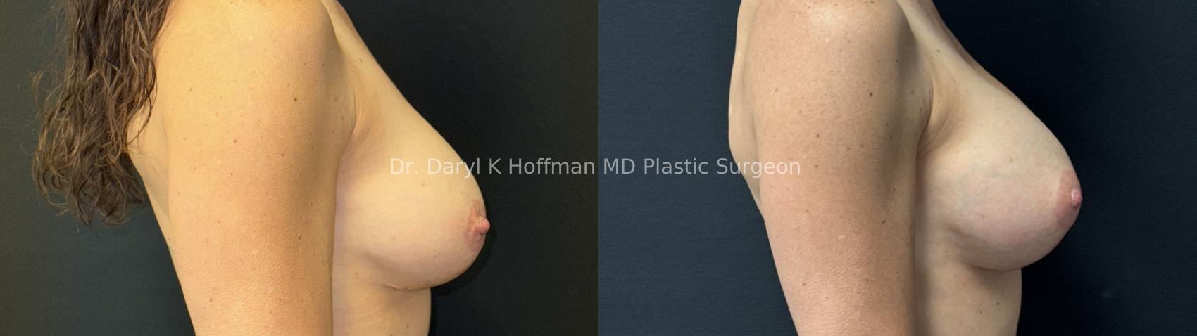 Implant Exchange  Case 91 Before & After Right Side | San Jose & Palo Alto, CA | Daryl K. Hoffman, MD