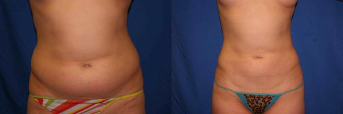 Liposuction Case 1 Before & After View #1 | San Jose & Palo Alto, CA | Daryl K. Hoffman, MD