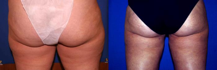 Liposuction Case 22 Before & After View #2 | San Jose & Palo Alto, CA | Daryl K. Hoffman, MD