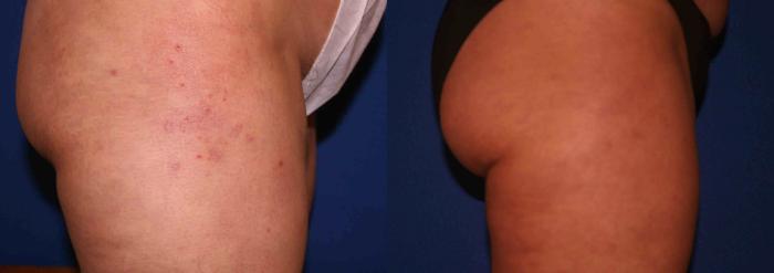Liposuction Case 22 Before & After View #3 | San Jose & Palo Alto, CA | Daryl K. Hoffman, MD