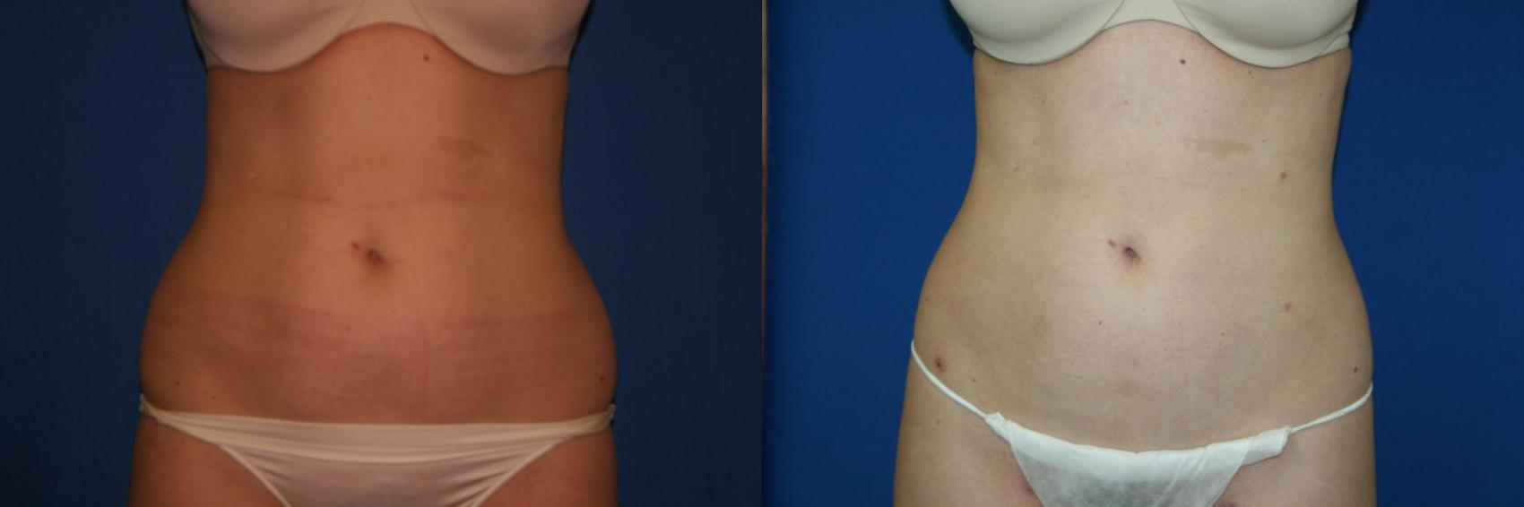 Liposuction Case 24 Before & After View #1 | San Jose & Palo Alto, CA | Daryl K. Hoffman, MD