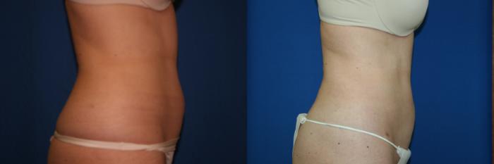 Liposuction Case 24 Before & After View #2 | San Jose & Palo Alto, CA | Daryl K. Hoffman, MD