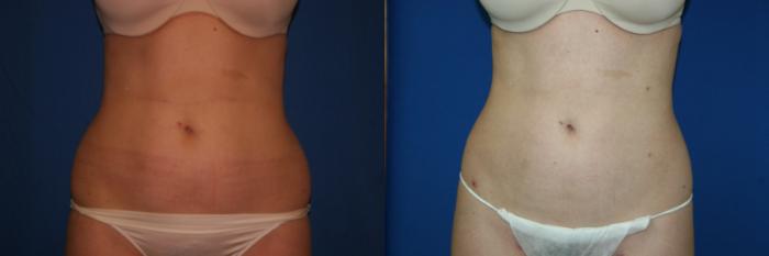 Liposuction Case 25 Before & After View #1 | San Jose & Palo Alto, CA | Daryl K. Hoffman, MD