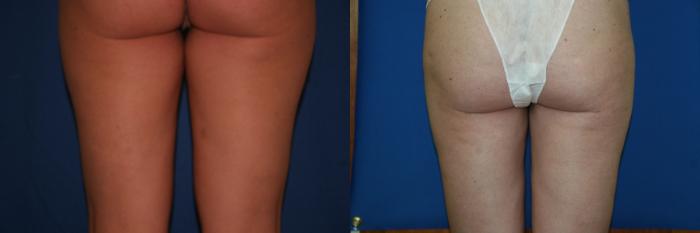 Liposuction Case 25 Before & After View #2 | San Jose & Palo Alto, CA | Daryl K. Hoffman, MD