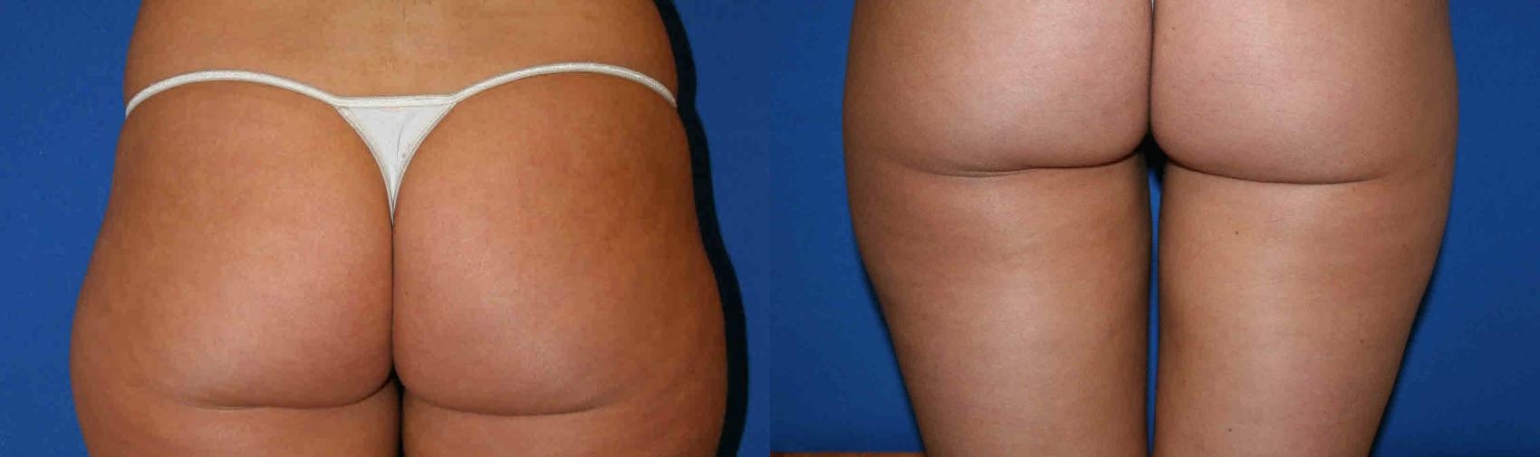 Liposuction Case 27 Before & After View #2 | San Jose & Palo Alto, CA | Daryl K. Hoffman, MD