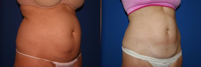 Liposuction Case 28 Before & After View #2 | San Jose & Palo Alto, CA | Daryl K. Hoffman, MD