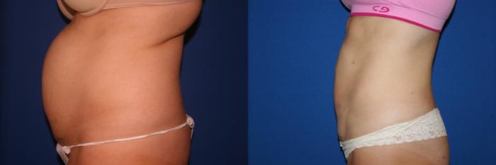 Liposuction Case 28 Before & After View #3 | San Jose & Palo Alto, CA | Daryl K. Hoffman, MD