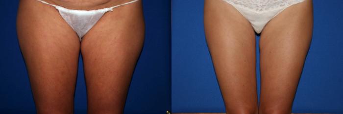 Liposuction Case 29 Before & After View #1 | San Jose & Palo Alto, CA | Daryl K. Hoffman, MD