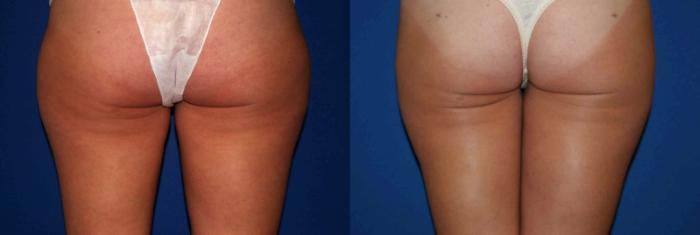 Liposuction Case 29 Before & After View #2 | San Jose & Palo Alto, CA | Daryl K. Hoffman, MD