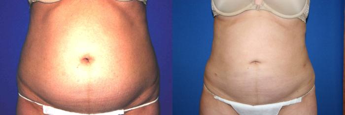 Liposuction Case 30 Before & After View #1 | San Jose & Palo Alto, CA | Daryl K. Hoffman, MD