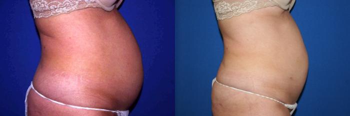 Liposuction Case 30 Before & After View #2 | San Jose & Palo Alto, CA | Daryl K. Hoffman, MD