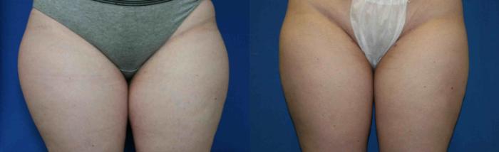 Liposuction Case 31 Before & After View #1 | San Jose & Palo Alto, CA | Daryl K. Hoffman, MD