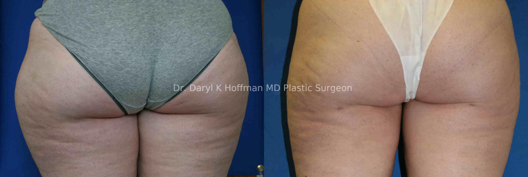 Liposuction Case 31 Before & After View #2 | San Jose & Palo Alto, CA | Daryl K. Hoffman, MD