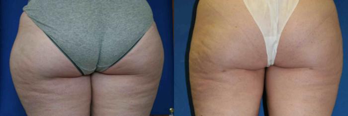 Liposuction Case 31 Before & After View #2 | San Jose & Palo Alto, CA | Daryl K. Hoffman, MD