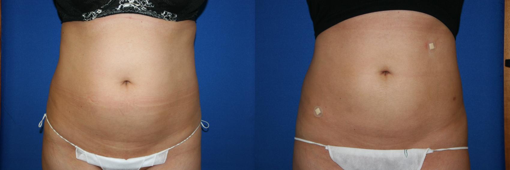 Liposuction Case 32 Before & After View #1 | San Jose & Palo Alto, CA | Daryl K. Hoffman, MD