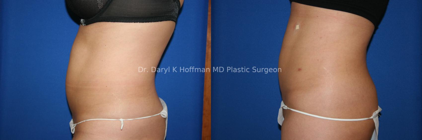 Liposuction Case 32 Before & After View #2 | San Jose & Palo Alto, CA | Daryl K. Hoffman, MD