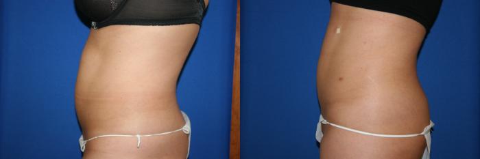 Liposuction Case 32 Before & After View #2 | San Jose & Palo Alto, CA | Daryl K. Hoffman, MD
