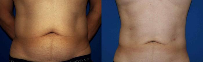 Liposuction Case 33 Before & After View #1 | San Jose & Palo Alto, CA | Daryl K. Hoffman, MD