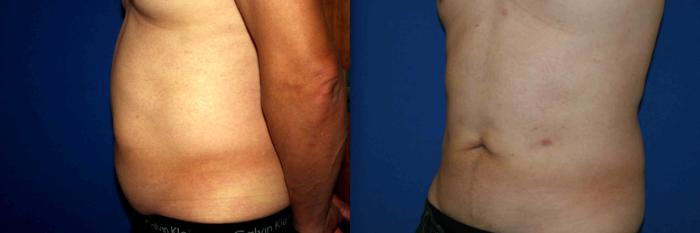 Liposuction Case 33 Before & After View #2 | San Jose & Palo Alto, CA | Daryl K. Hoffman, MD
