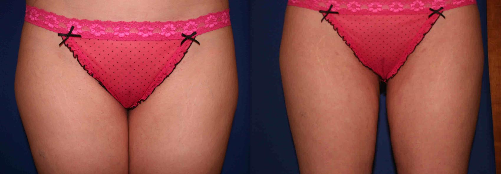 Liposuction Case 34 Before & After View #1 | San Jose & Palo Alto, CA | Daryl K. Hoffman, MD