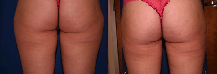 Liposuction Case 34 Before & After View #2 | San Jose & Palo Alto, CA | Daryl K. Hoffman, MD
