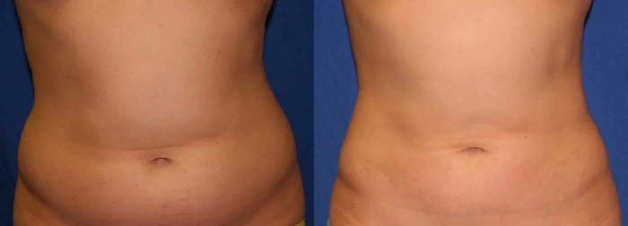 Liposuction Case 40 Before & After View #1 | San Jose & Palo Alto, CA | Daryl K. Hoffman, MD