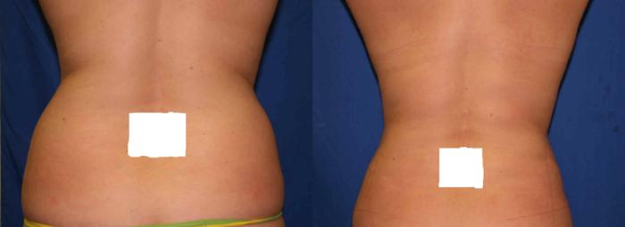 Liposuction Case 40 Before & After View #2 | San Jose & Palo Alto, CA | Daryl K. Hoffman, MD